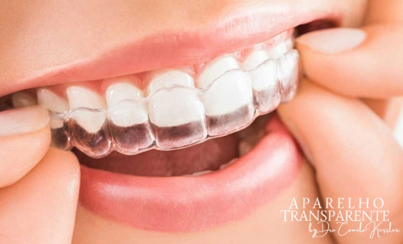 Consulta de Aprovação do Tratamento com Invisalign - Vs Ortodontia