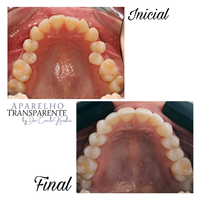 Quem tem implante dentário pode usar Invisalign®? – Dental Expert