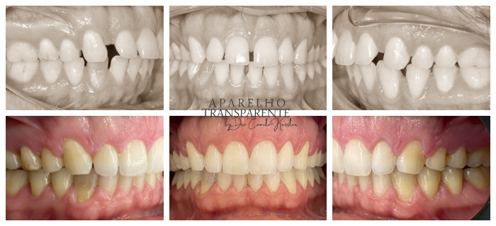 Profile Ortodontia - Antes e depois Invisalign @invisalign é um aparelho  transparente para todas as idades! Venha você também encontrar a melhor  versão do seu sorriso com Invisalign! #invisalign #invisalignbrasil  #dentista #antesedepois