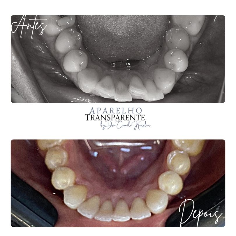 Antes e depois Invisalign - Profile Ortodontia