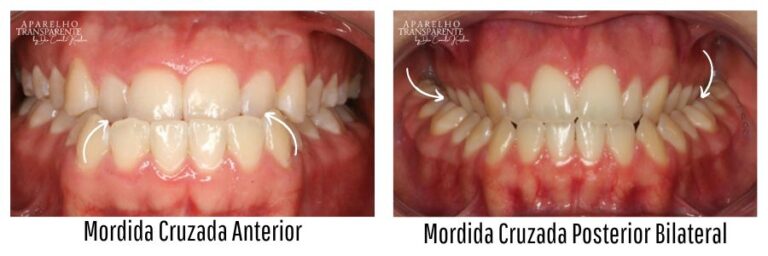 mordida cruzada posterior e anterior