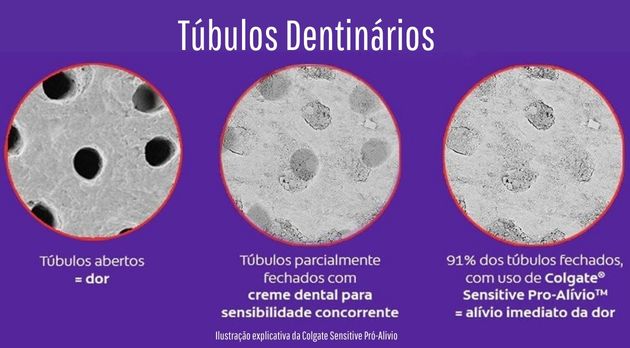 pasta dental para dentes sensíveis fecha os tubulos dentinarios