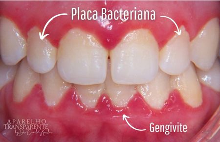 placa bacteriana e gengivite