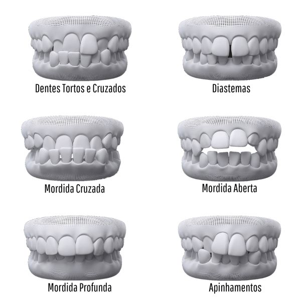 Diferença entre alinhadores Invisalign e outras marcas comerciais – AGN  Odontologia
