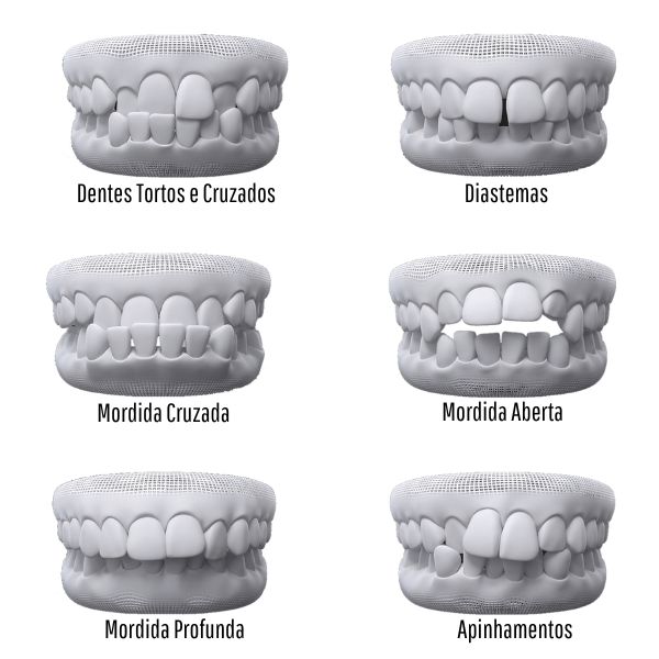 Ortodontia corrige mordida cruzada dentes tortos espacos