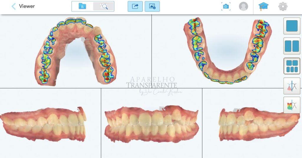escaneamento intraoral aparelho transparente