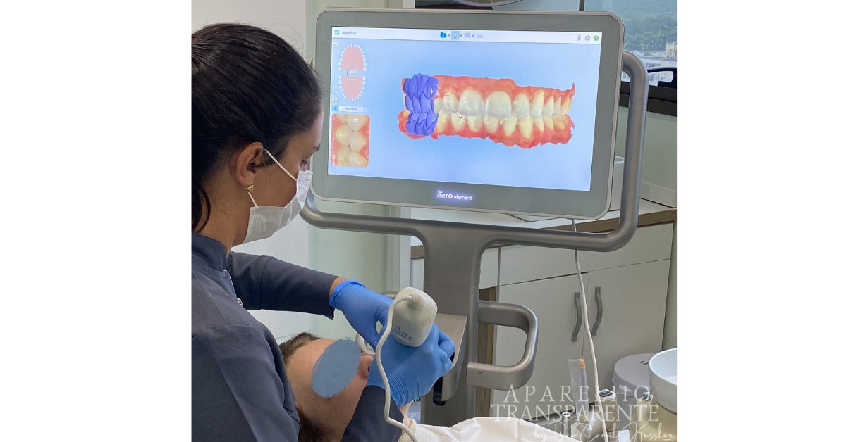 escaneamento intra oral aparelho transparente